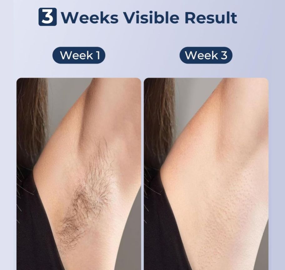 lubex ipl hair growth comparison at weeks 1 and 3